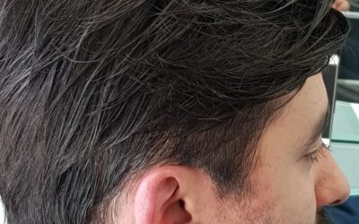 Trapianto non chirurgico: una soluzione innovativa per la perdita dei capelli