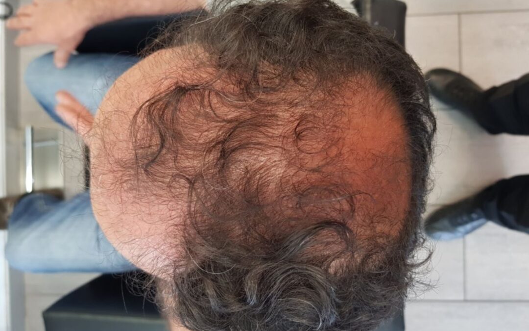 perché cadono i capelli