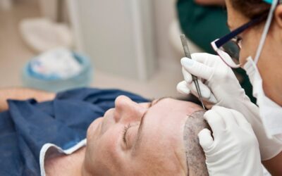 Trapianto di capelli F.U.E. per ritrovare la chioma